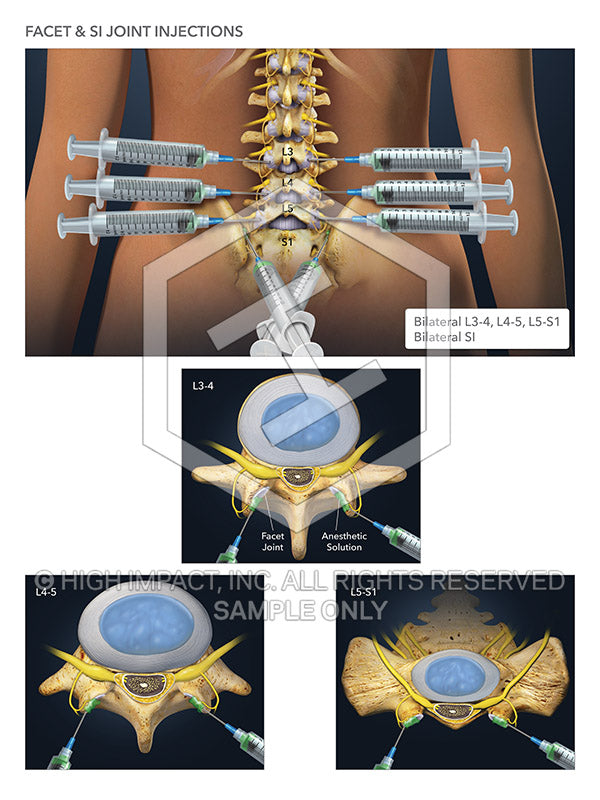 Image 08298_im02: Facet and SI Joint Injections Illustration - Trial Guides