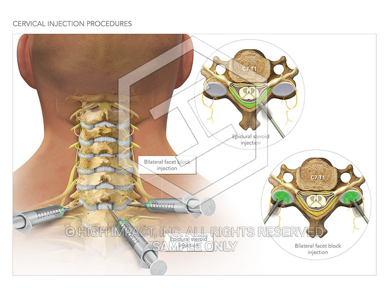 Image 10363_im02: Cervical Facet Injections Illustration - Trial Guides
