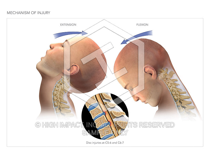 Image 10568_im02: Mechanism of Injury Illustration - Trial Guides