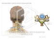Image 13082_im01: Cervical Epidural Steroid Injections Illustration - Trial Guides