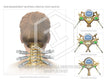 Image 13082_im02: Cervical Facet Block Injections Illustration - Trial Guides
