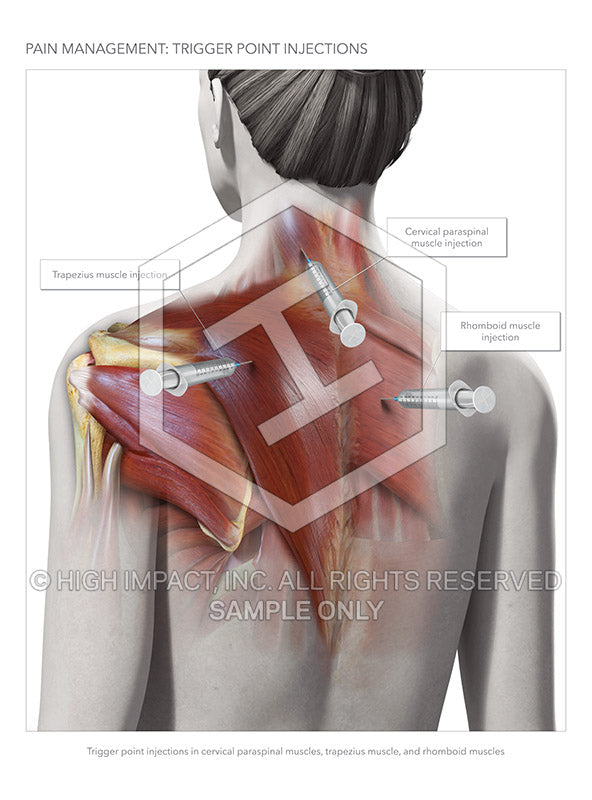 Image 13082_im04: Cervical and Thoracic Trigger Point Injections  Illustration