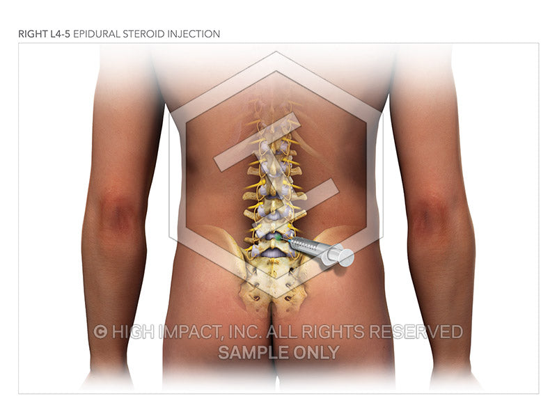 Image 13524: L4-5 Epidural Steroid Injections Illustration - Trial Guides