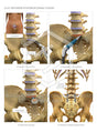 Image 13558: Anterior Posterior Discectomy and Fusion Surgery of L5-S1 Illustration - Trial Guides