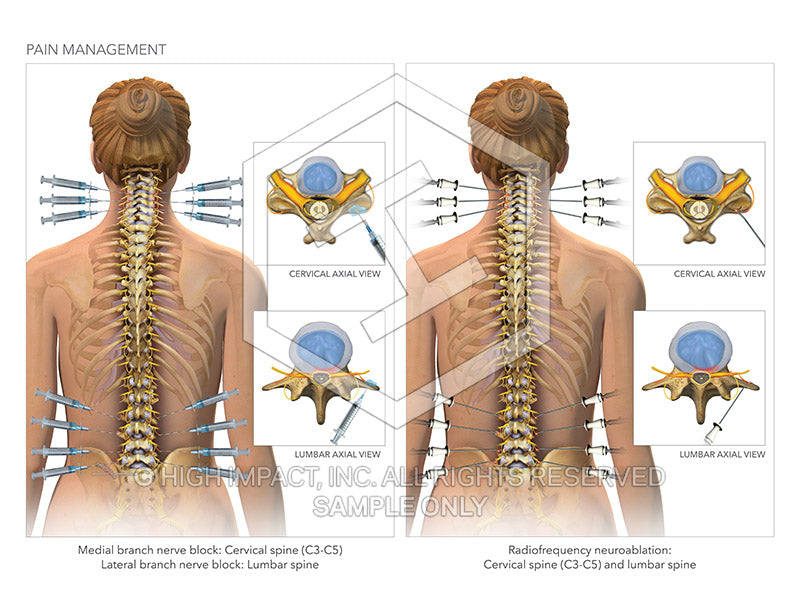 Image 13923: Cervical Spine and Lumbar Spine Medial Branch Blocks and Radiofrequency Neuroablation Illustration - Trial Guides