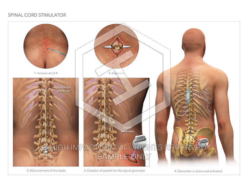 Image 14373: Spinal Cord Stimulator Illustration