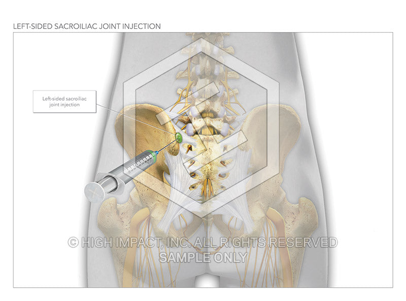 Image 14518: Sacroiliac Joint Injections Illustration - Trial Guides