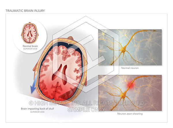 Image 18350_im02: Traumatic Brain Injury Illustration - Trial Guides