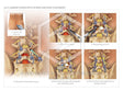 Image 18372: Lumbar Fusion Surgery at L4-L5 Using an Autograft Illustration - Trial Guides