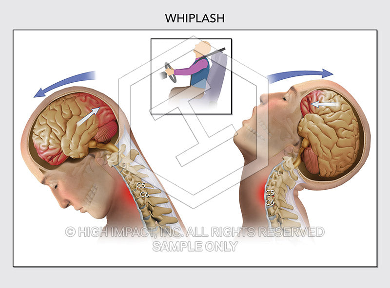 Image 08011: Whiplash Illustration - Trial Guides