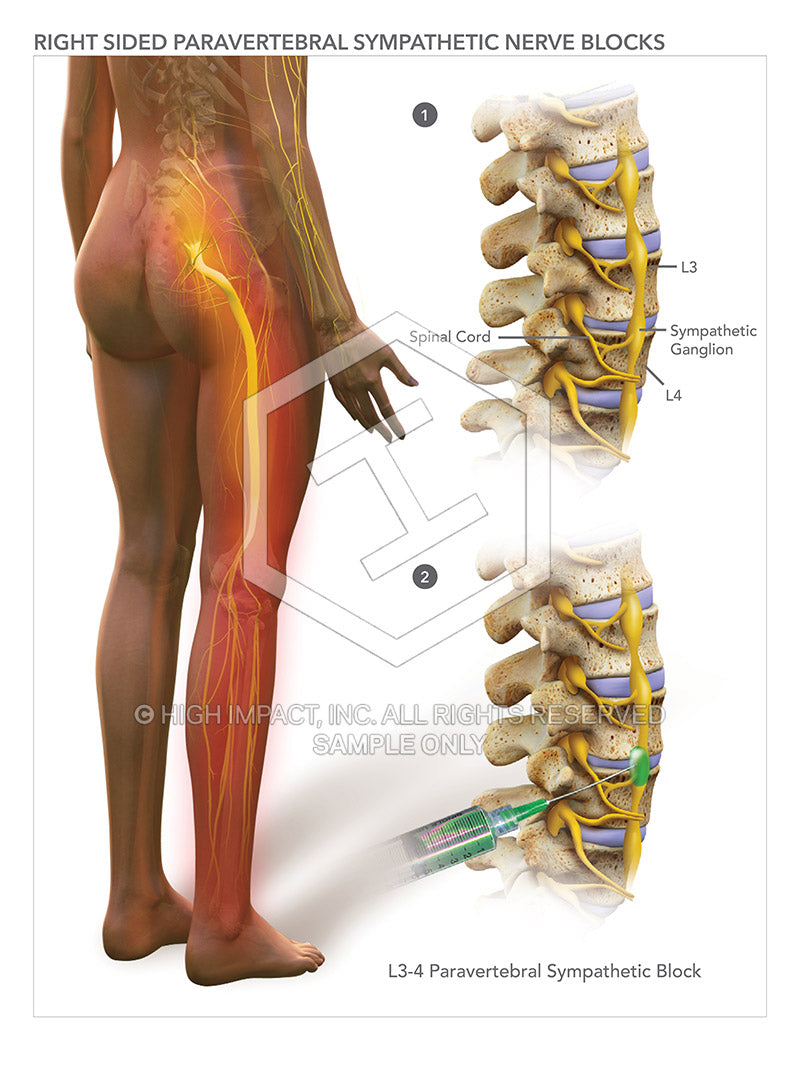 Image 08252: Right Sided Paravertebral Sympathetic Nerve Blocks Illustration - Trial Guides