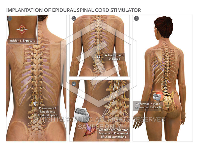 Image 08334: Implantation of Epidural Spinal Cord Stimulator Illustration - Trial Guides