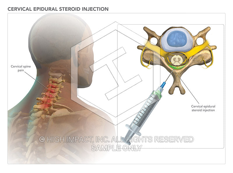 Image 08435: Cervical Epidural Steroid Injection - Trial Guides