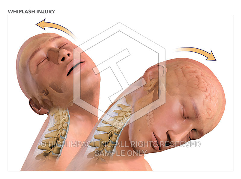Image 08469: Whiplash Injury Illustration - Trial Guides