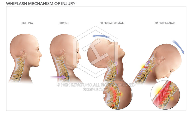 Image 08610: Whiplash Mechanism of Injury Illustration - Trial Guides