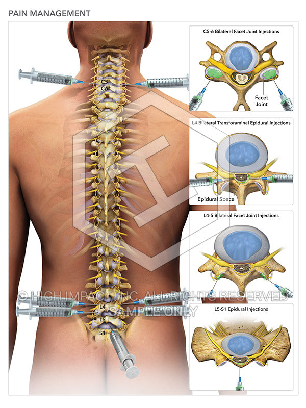 Image 08627: Spinal Pain Management Injections Illustration - Trial Guides