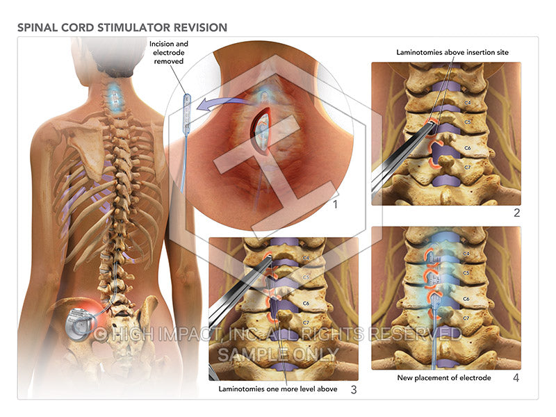 Image 08668: Spinal Cord Stimulator Revision Illustration - Trial Guides