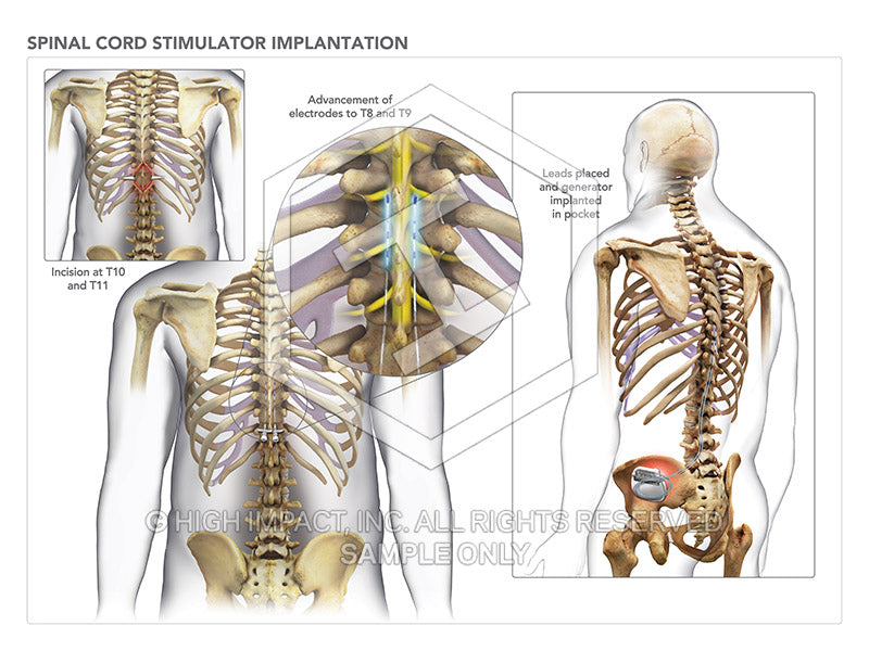 Image 08760: Thoracic Spinal Cord Stimulator Implantation Illustration - Trial Guides