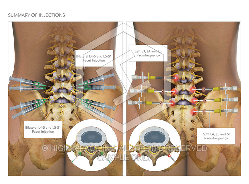 Image 08876: Lumbar Pain Management Injections Illustration - Trial Guides