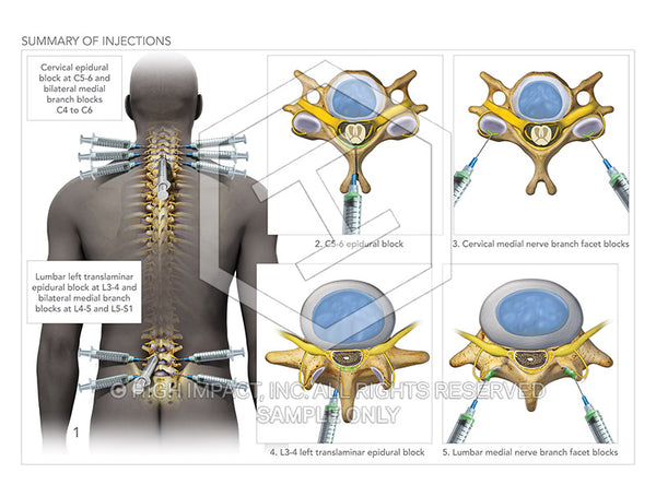 Image 08906: Spinal Pain Management Injection Illustration