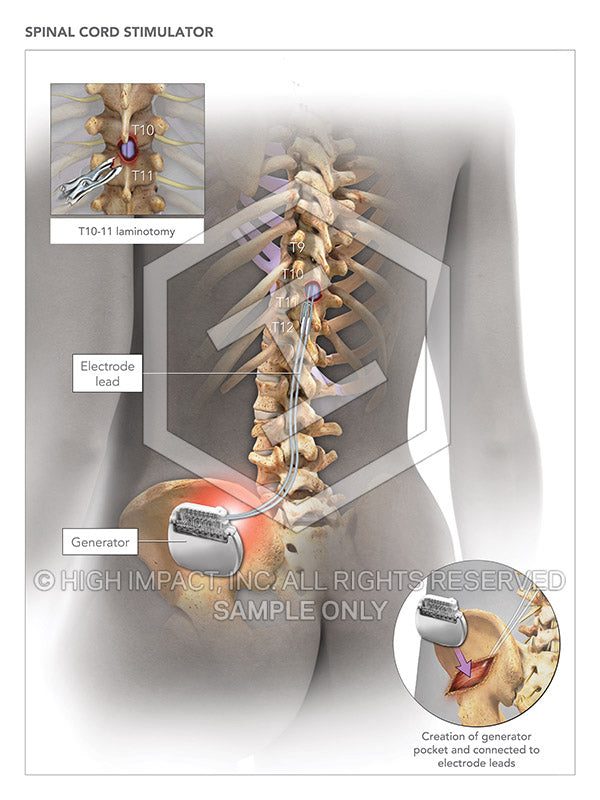 Image 08916-im01: Spinal Cord Stimulator (Left) Illustration