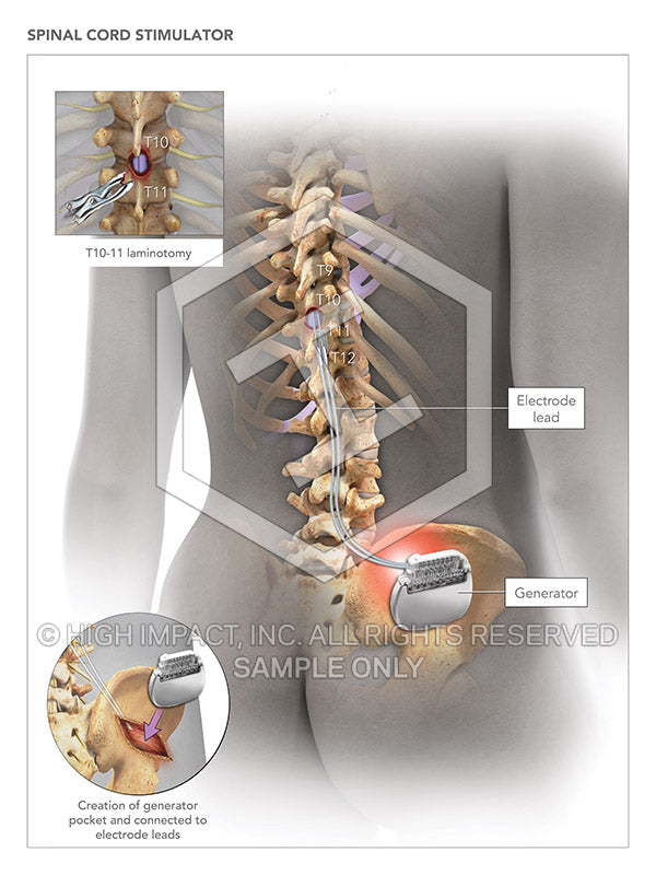 Image 08916-im02: Spinal Cord Stimulator (Right) Illustration