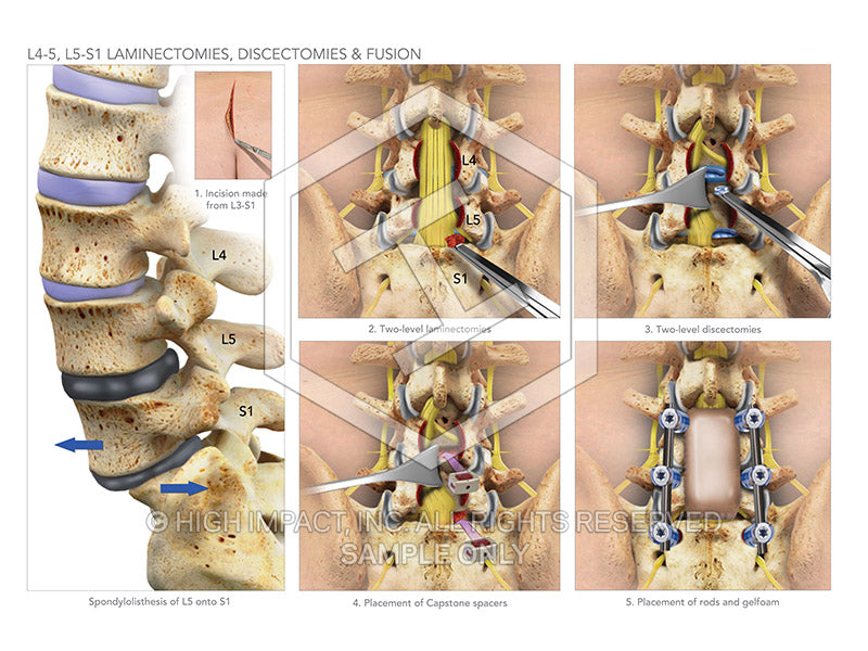 Image 08922: L4-5, L5-S1 Laminectomies, Discectomies & Fusion Illustra ...