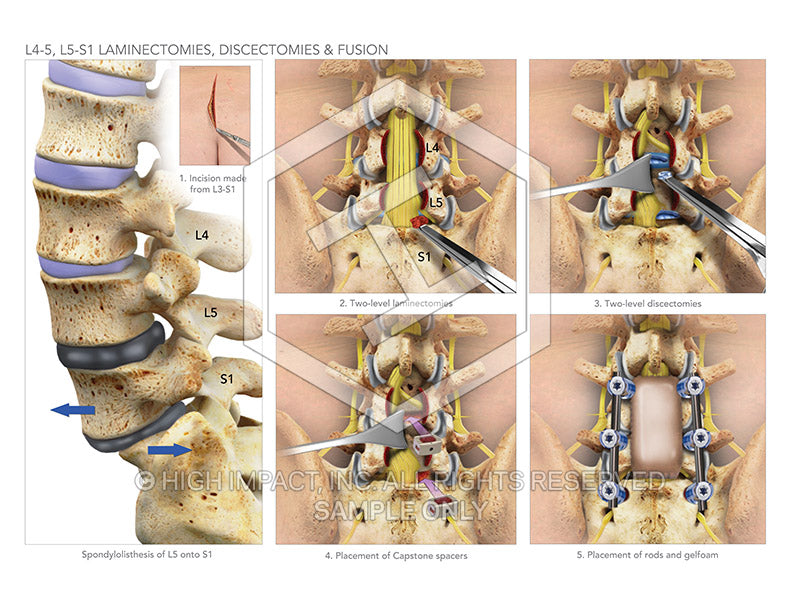 Image 08922: L4-5, L5-S1 Laminectomies, Discectomies & Fusion Illustration - Trial Guides