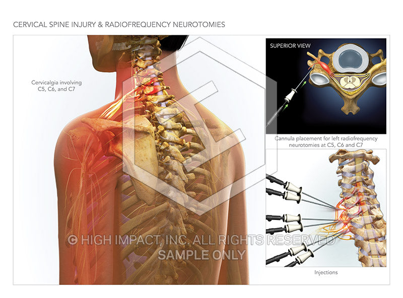 Image 09154: Cervical Spine Injury & Radiofrequency Neurotomies Illustration