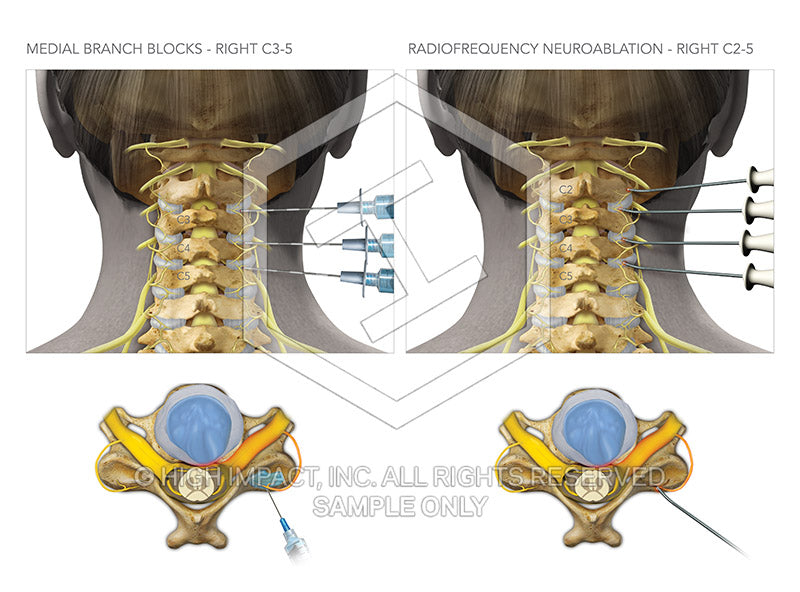 Image 09175: Cervical Spine Medial Branch Blocks and Radiofrequency Neuroablation Illustration