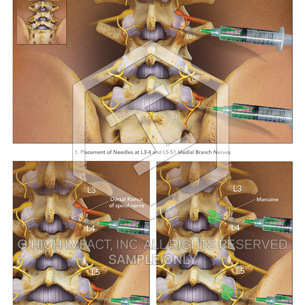 Androgenic Ramus Dorsal Ramus
