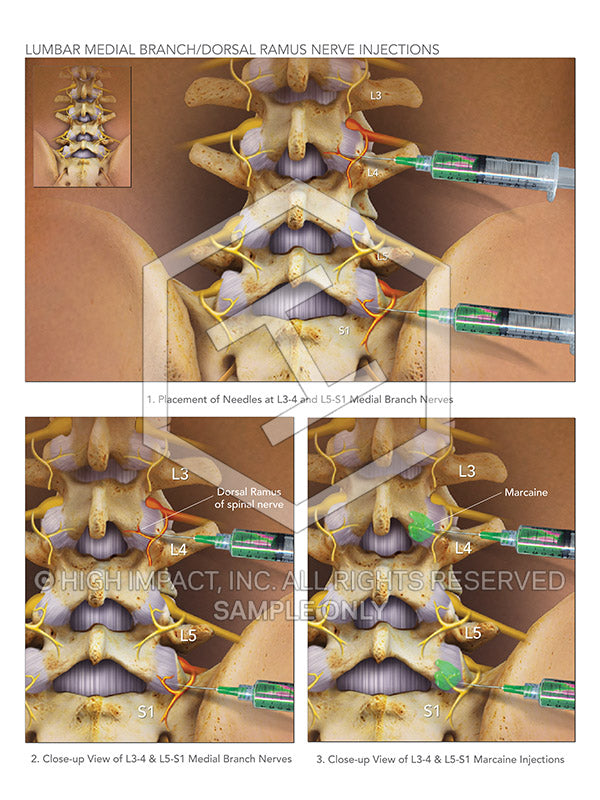Image 09197_im01: Lumbar Medial Branch / Dorsal Ramus Nerve Injections Illustration - Trial Guides