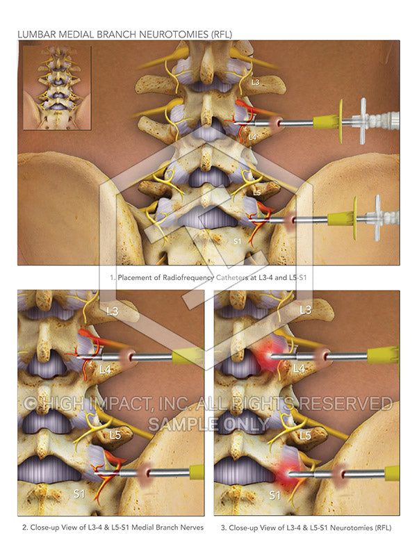 Image 09197_im02: Lumbar Spine Medial Branch Neurotomies Illustration - Trial Guides