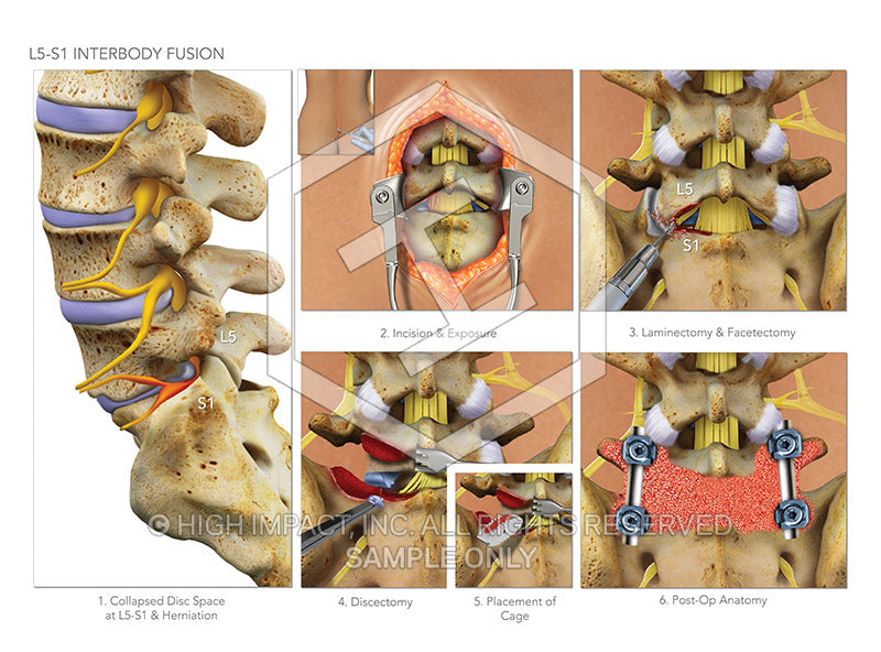 Image 09197_im03: L5-S1 Interbody Fusion Surgery - Trial Guides