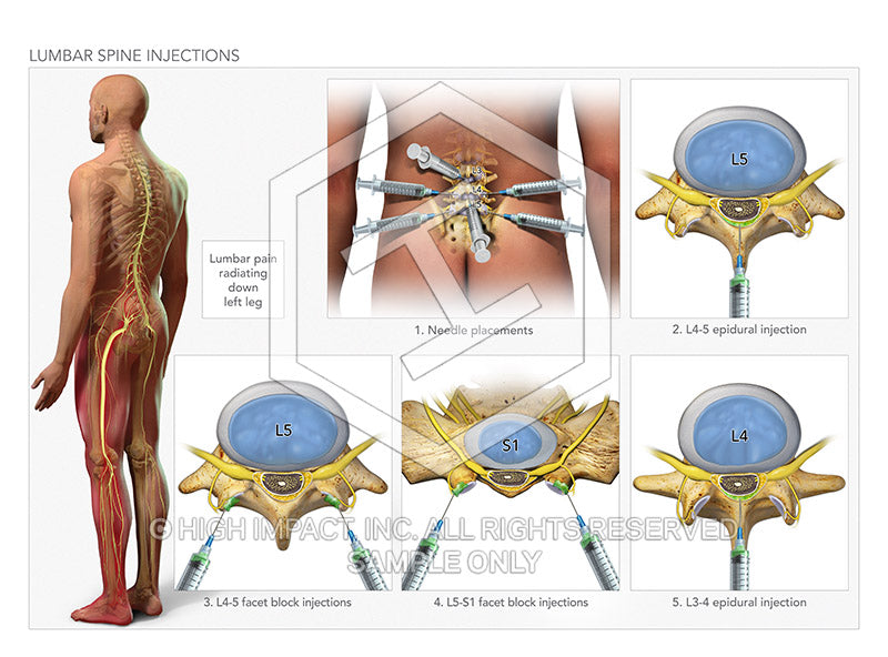 Image 09207: Lumbar Spine Injections Illustration