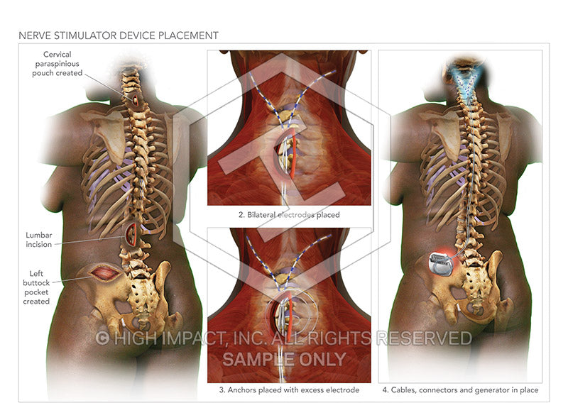 Image 09303: Cervical Nerve Stimulator Device Placement Surgery Illustration