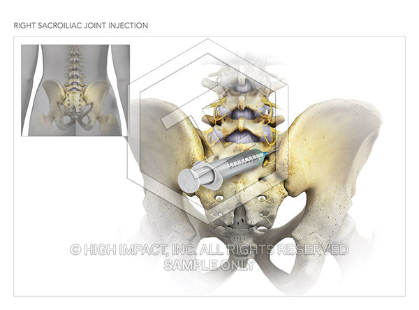 Image 09332: Right Sacroiliac Joint Injection Illustration - Trial Guides