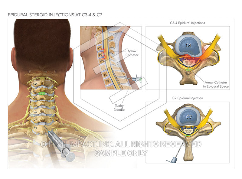 Image 09373: Epidural Steroid Injections in the Cervical Spine Illustration - Trial Guides