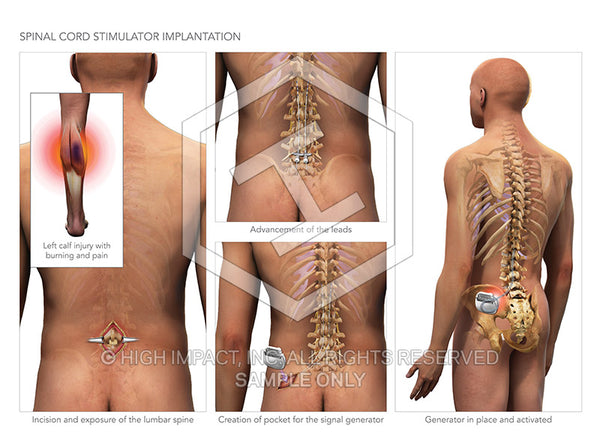 Image 09384: Spinal Cord Stimulator Illustration - Trial Guides
