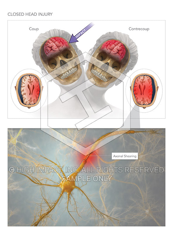 Image 09612: Closed Head Injury Illustration - Trial Guides