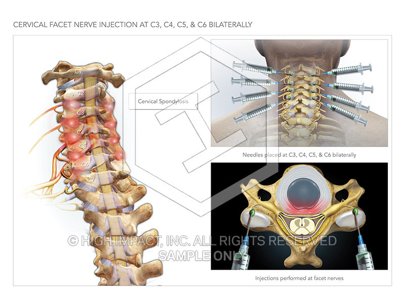 Image 09765_im01: Cervical Facet Nerve Injection at C3, C4, C5 & C6 Bilaterally Illustration - Trial Guides