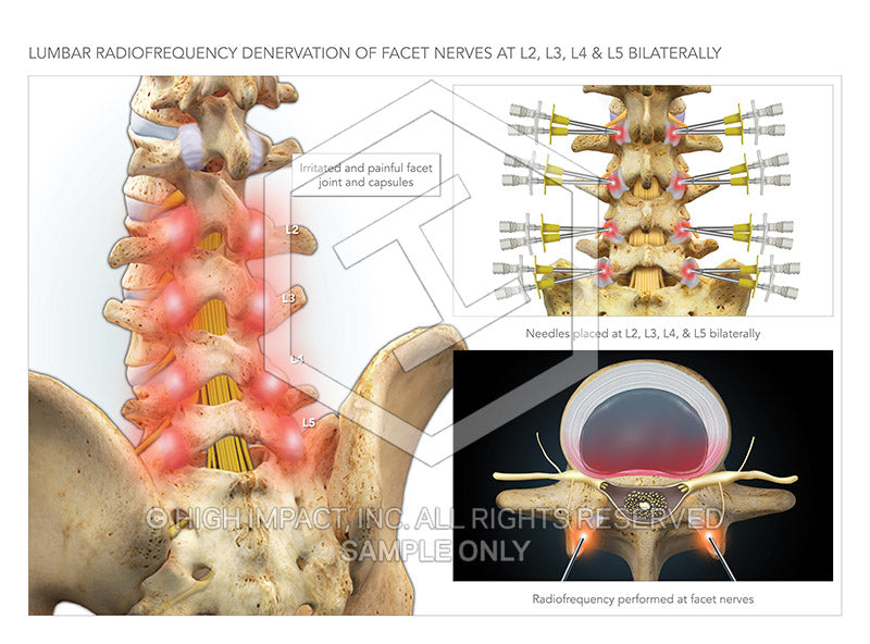 Image 09765_im02: Lumbar Radiofrequency Denervation of Facet Nerves at L2, L3, L4 and L5 Bilaterally Illustration - Trial Guides