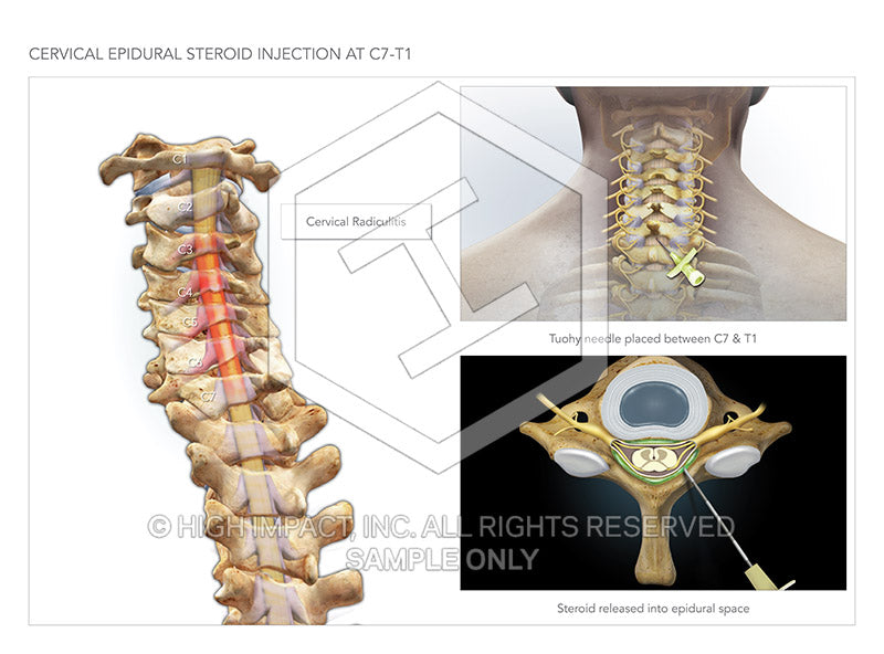 Image 09765_im03: Cervical Epidural Steroid Injections at C7-T1 Illustration - Trial Guides
