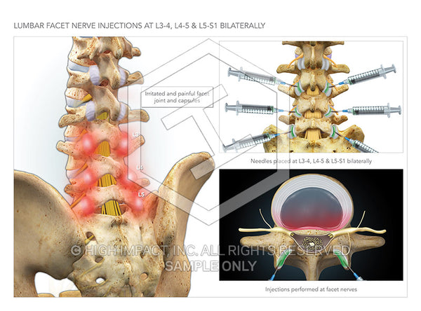 Image 09765_im04: Lumbar Facet Nerve Injections at L3-4, L4-5, L5-S1 Bilaterally Illustration - Trial Guides