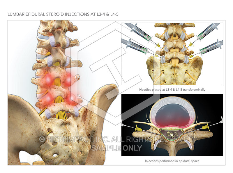 Image 09765_im05: Lumbar Epidural Steroid Injections at L3-4 and L4-5 Illustration - Trial Guides