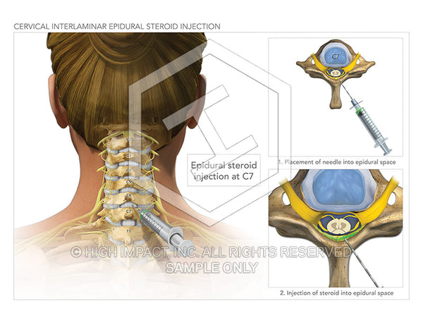 Image 09830_im01: Cervical Interlaminar Epidural Steroid Injections Illustration - Trial Guides