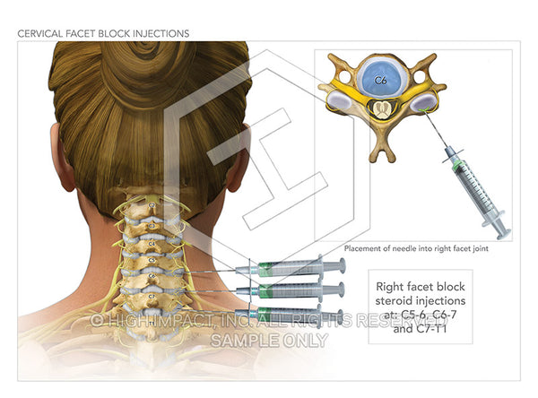 Image 09830_im02: Cervical Facet Block Injections Illustration - Trial Guides