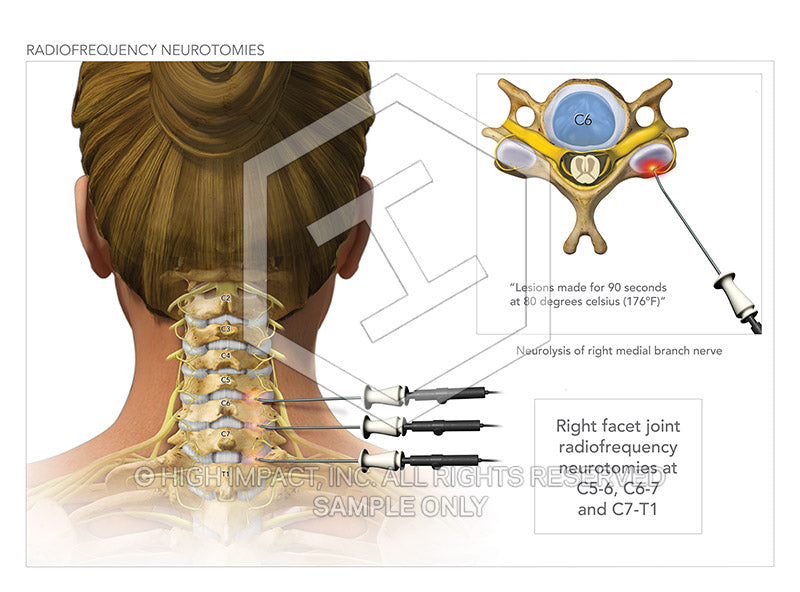 Image 09830_im03: Cervical Radiofrequency Neurotomies Illustration - Trial Guides