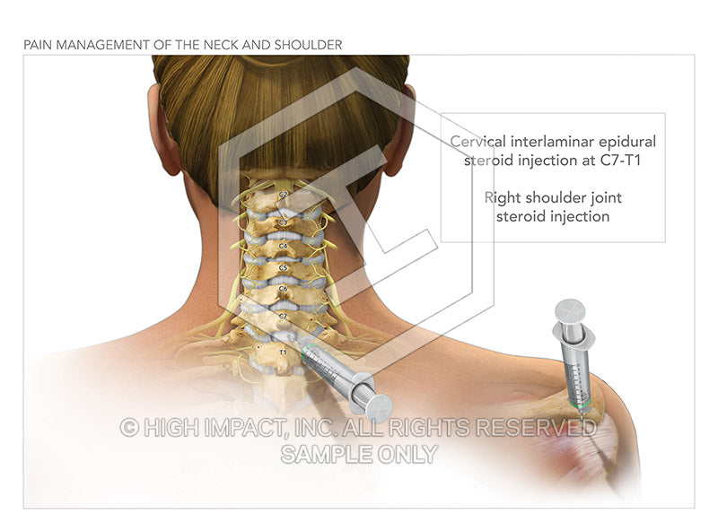 Image 09830_im04: Pain Management of the Neck and Shoulder Illustration - Trial Guides