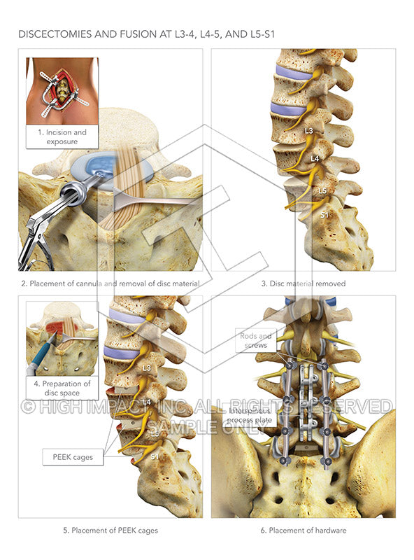 Image 09927: Discectomies and Fusion Surgery at L3-4, L4-5 and L5-S1 Illustration - Trial Guides